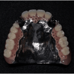  守山市の歯医者　歯科　金属床義歯