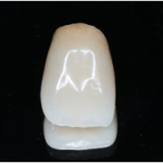  守山市の歯医者　歯科　セラミック治療