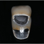  守山市の歯医者　歯科　セラミック治療