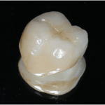  守山市の歯医者　歯科　セラミック治療