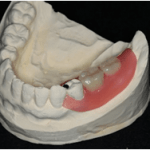  守山市の歯医者　歯科　見えない入れ歯