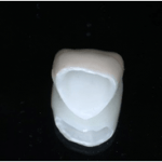  守山市の歯医者　歯科　セラミック治療