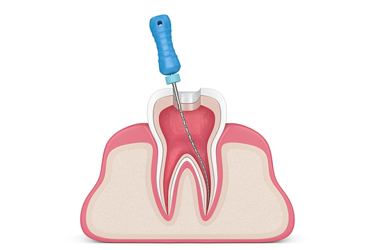  守山市の歯医者　根の治療