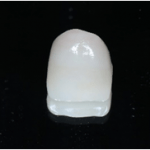  守山市の歯医者　歯科　セラミック治療