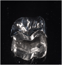  守山市歯医者　歯科　銀歯