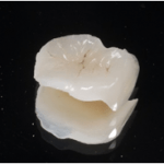  守山市の歯医者　歯　セラミック