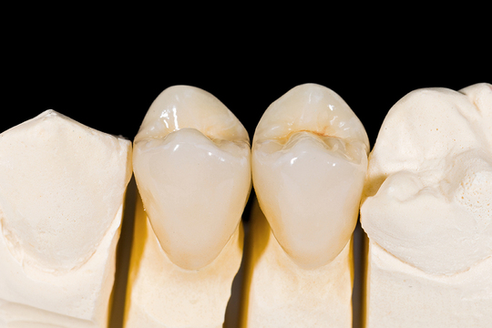  守山市の歯医者　歯科　セラミック治療