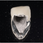  守山市歯医者　被せもの　