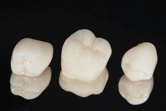  守山市の歯医者　歯科　セラミック治療